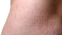 Cara Alami Samarkan Stretch Mark Tanpa Efek Samping, Coba 7 Bahan Alami Ini Dijamin Ampuh